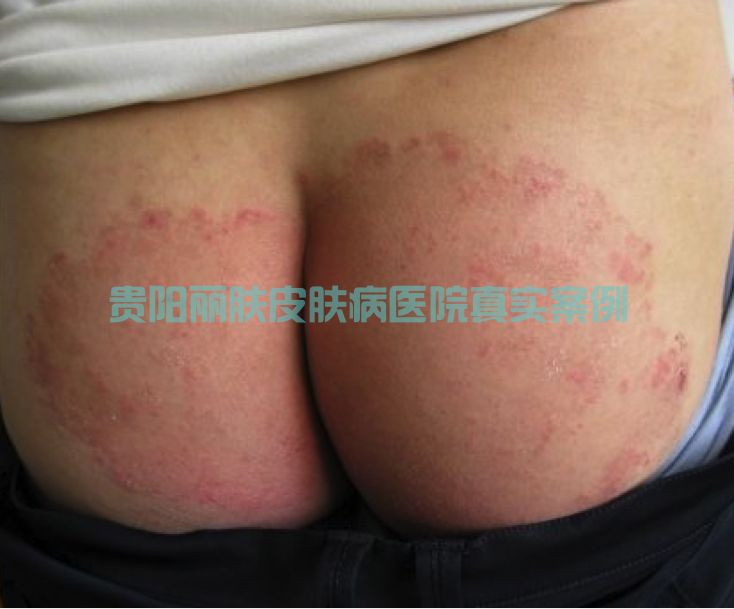 股癣