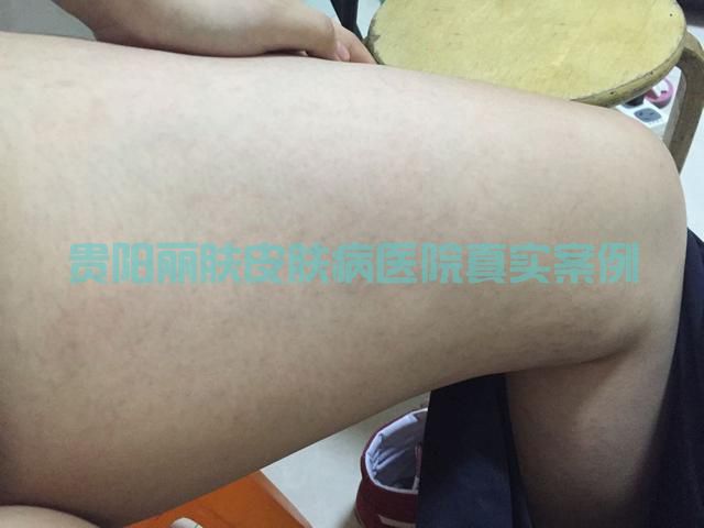肥胖纹